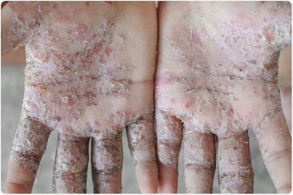 Infestación por sarna - Trastornos de la piel - Manual MSD versión para  público general